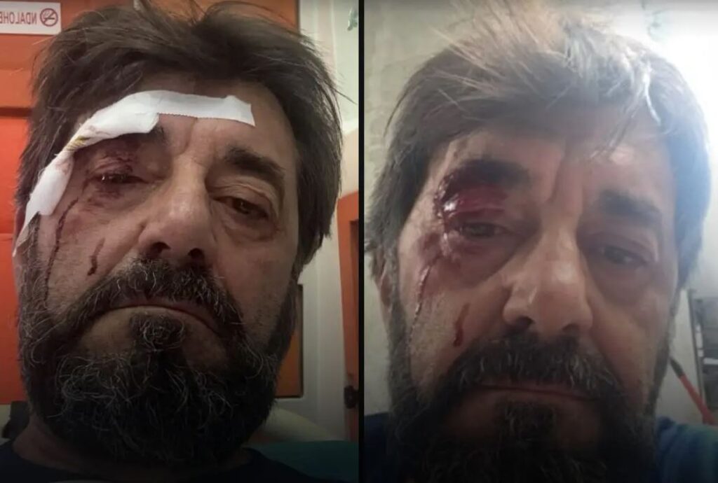 Dhunohet Ilir Demalia, analisti kallëzon në polici: Më sulmuan dy persona (FOTO)